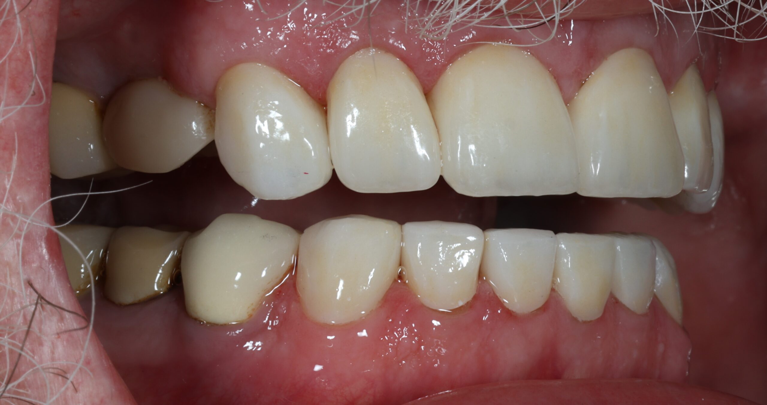 Patient 11 FMR 3 scaled - Dental Associates of Jersey City