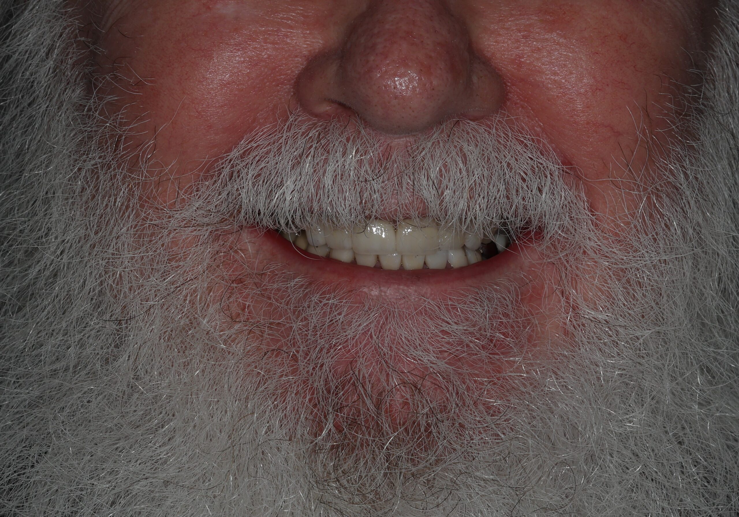 Patient 11 FMR After scaled - Dental Associates of Jersey City