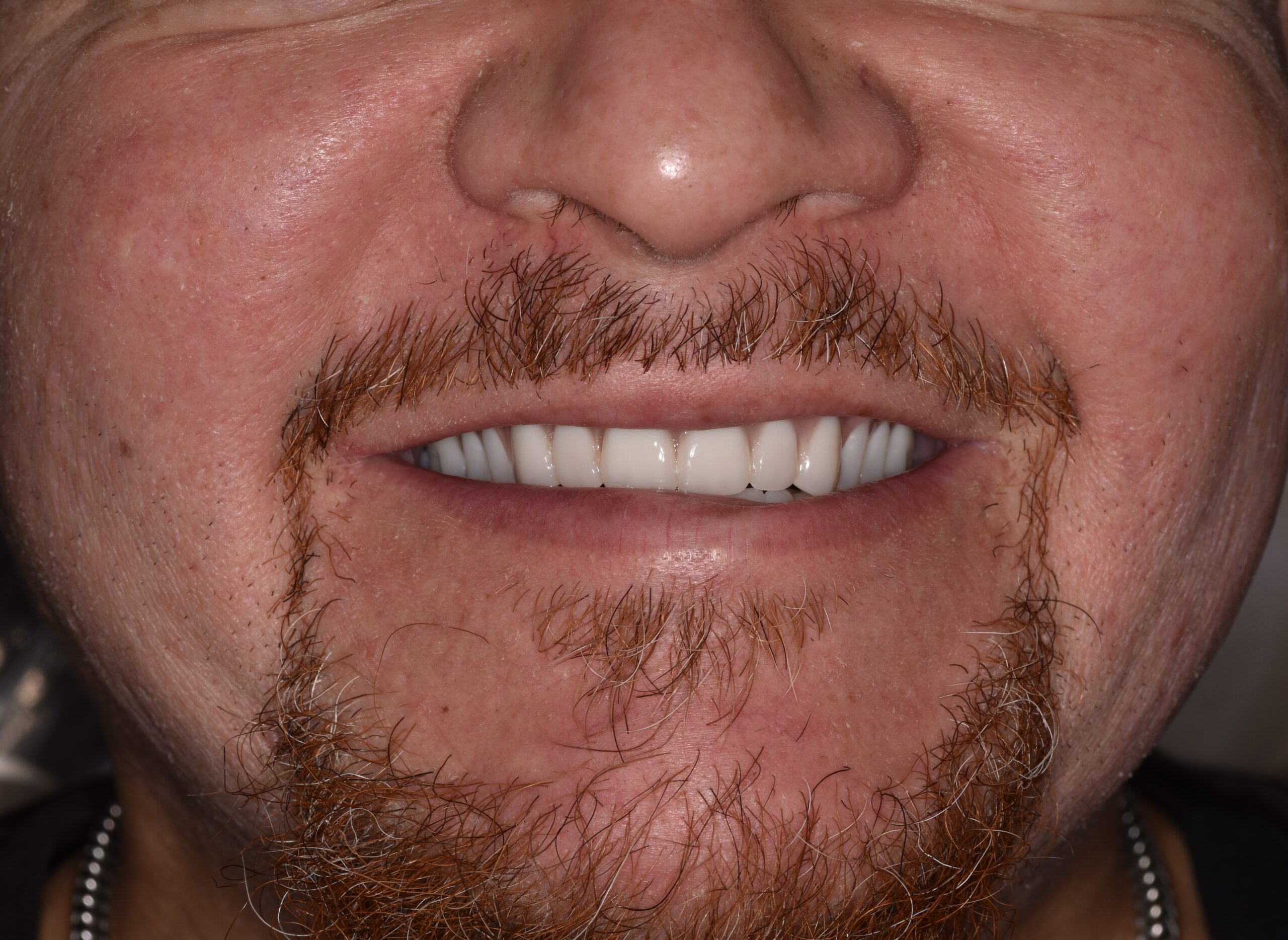 Patient 4 After scaled - Dental Associates of Jersey City