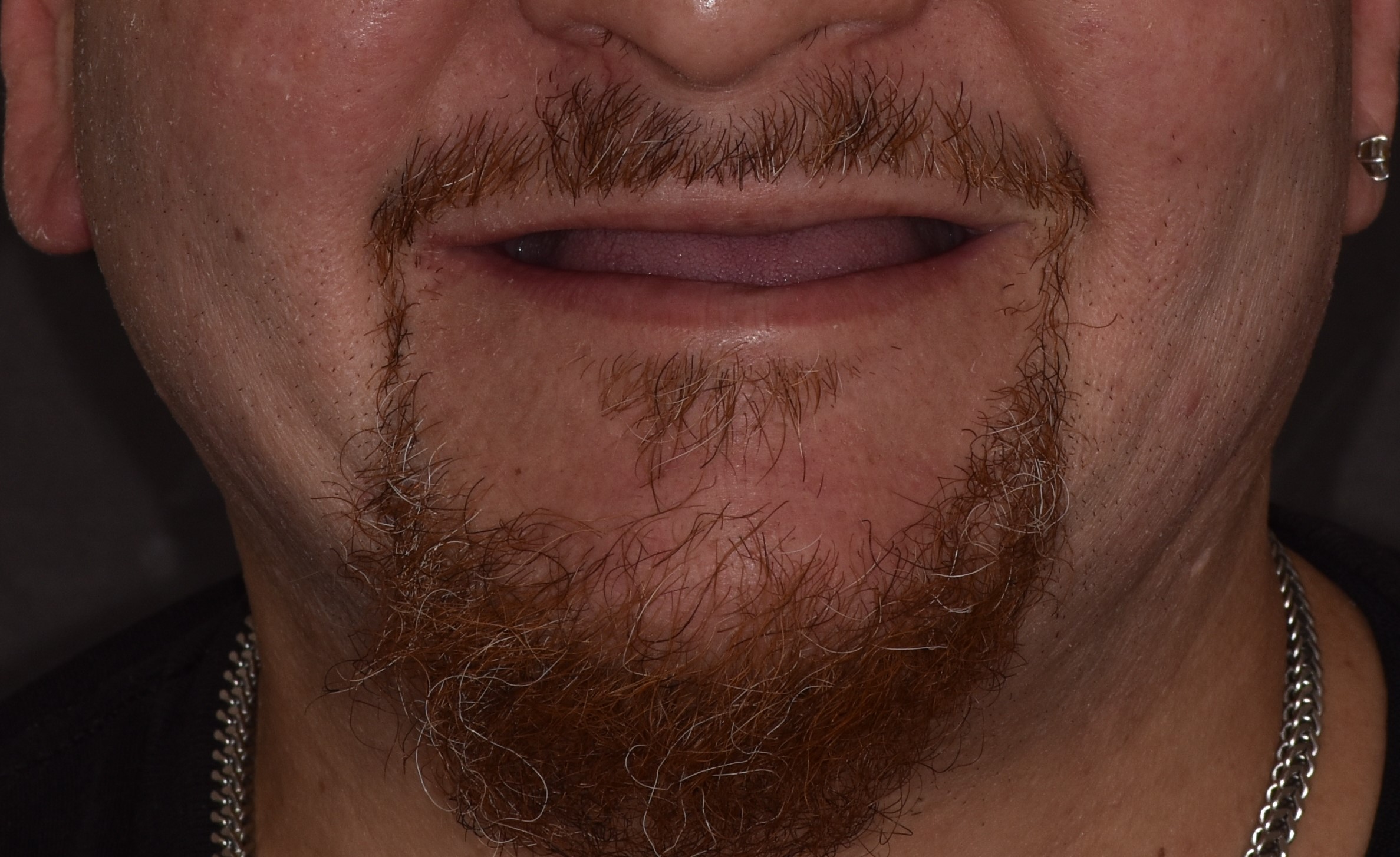 Patient 4 Before - Dental Associates of Jersey City