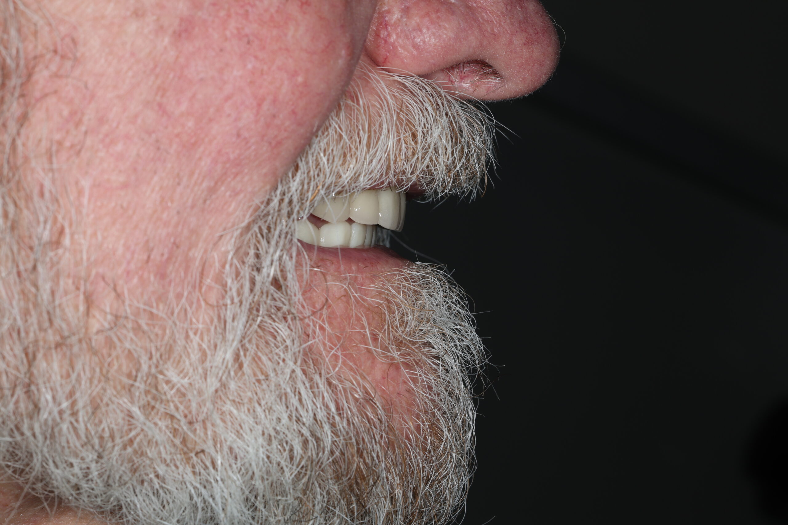 Patient 6 FMR After 2 scaled - Dental Associates of Jersey City