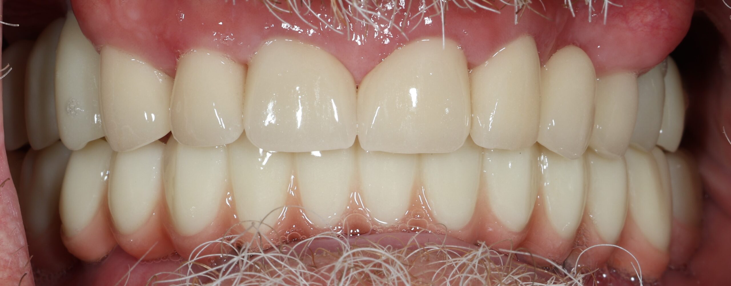 Patient 6 FMR After 3 scaled - Dental Associates of Jersey City