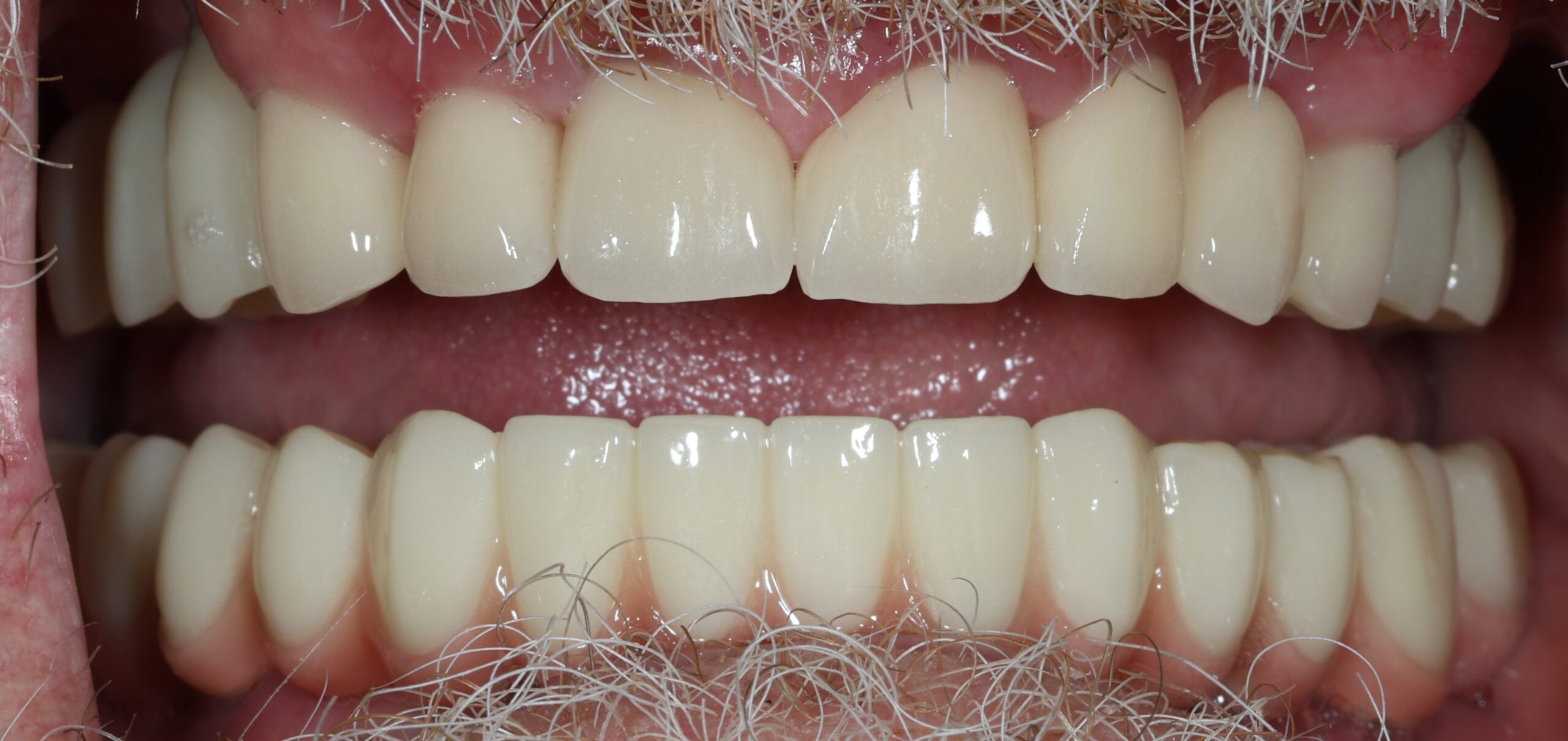 Patient 6 FMR After 4 scaled - Dental Associates of Jersey City