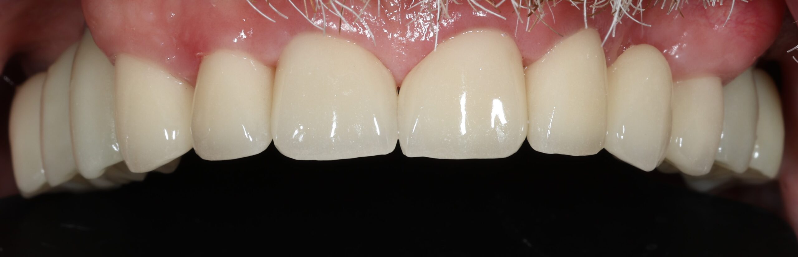 Patient 6 FMR After 6 scaled - Dental Associates of Jersey City