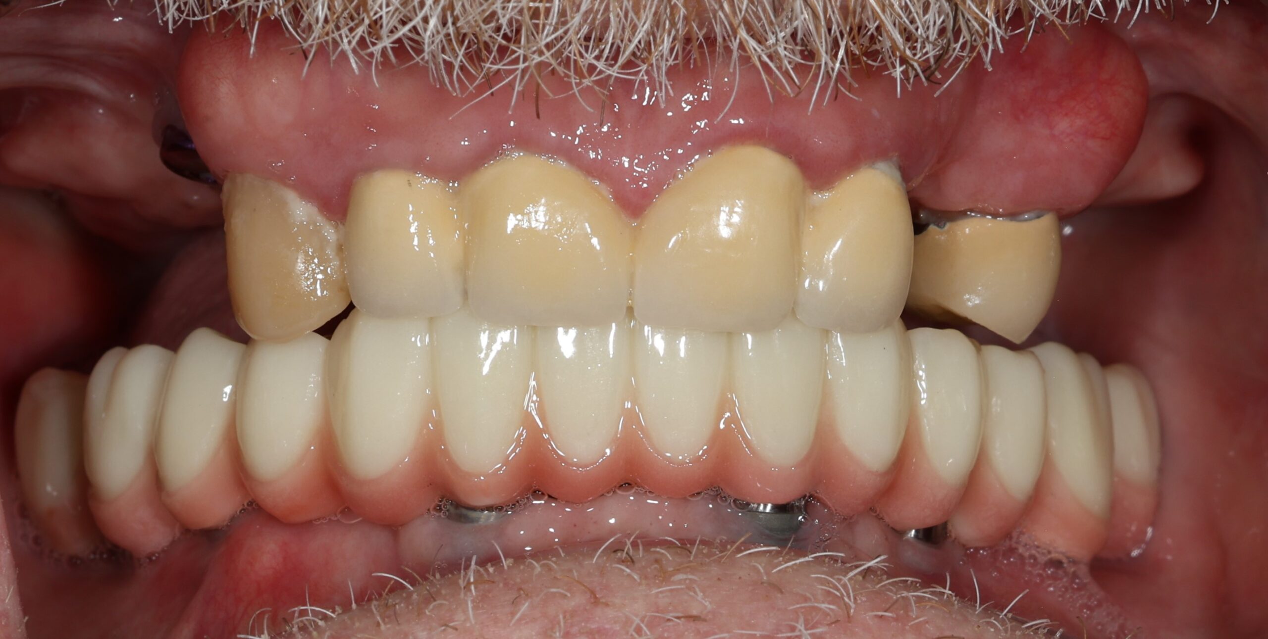 Patient 6 FMR Before 2 scaled - Dental Associates of Jersey City