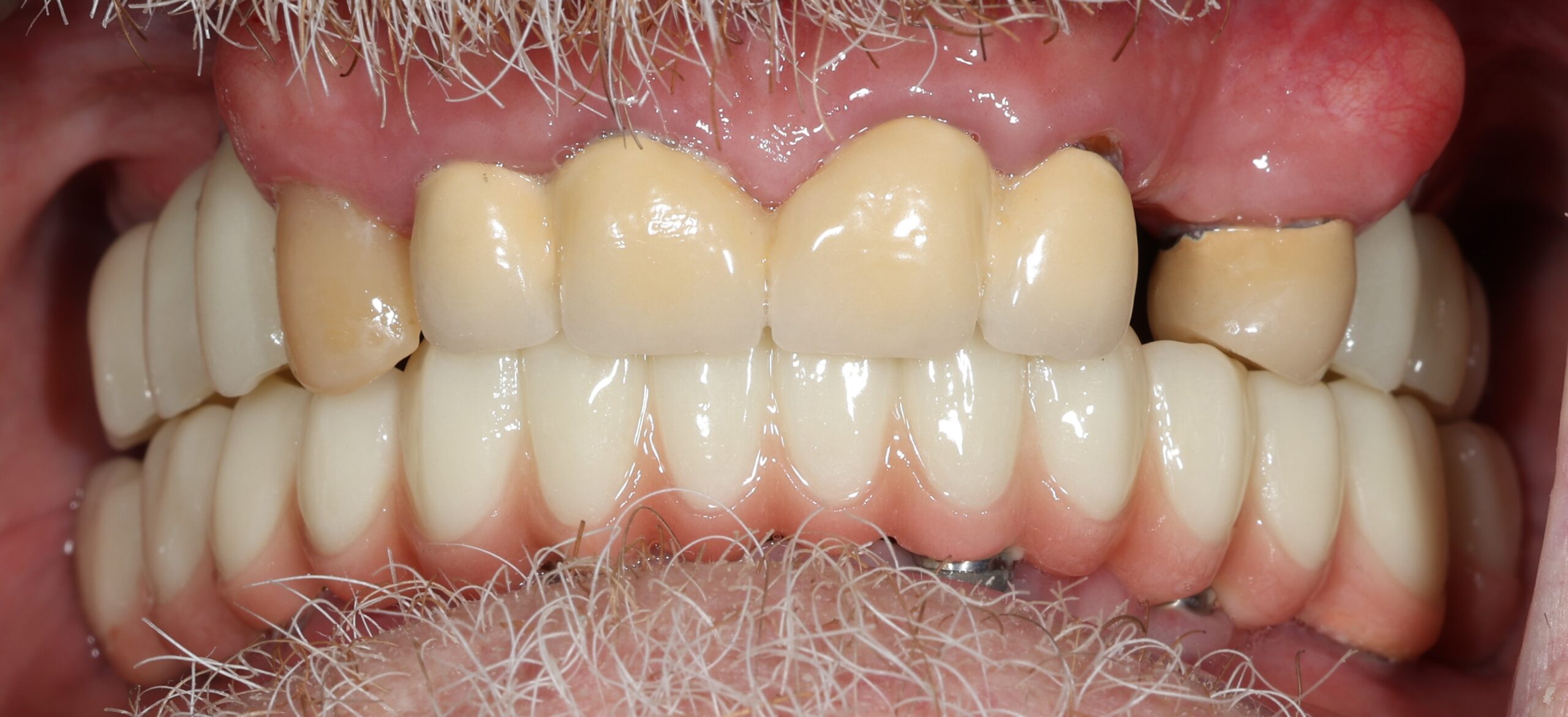 Patient 6 FMR Before 3 scaled - Dental Associates of Jersey City