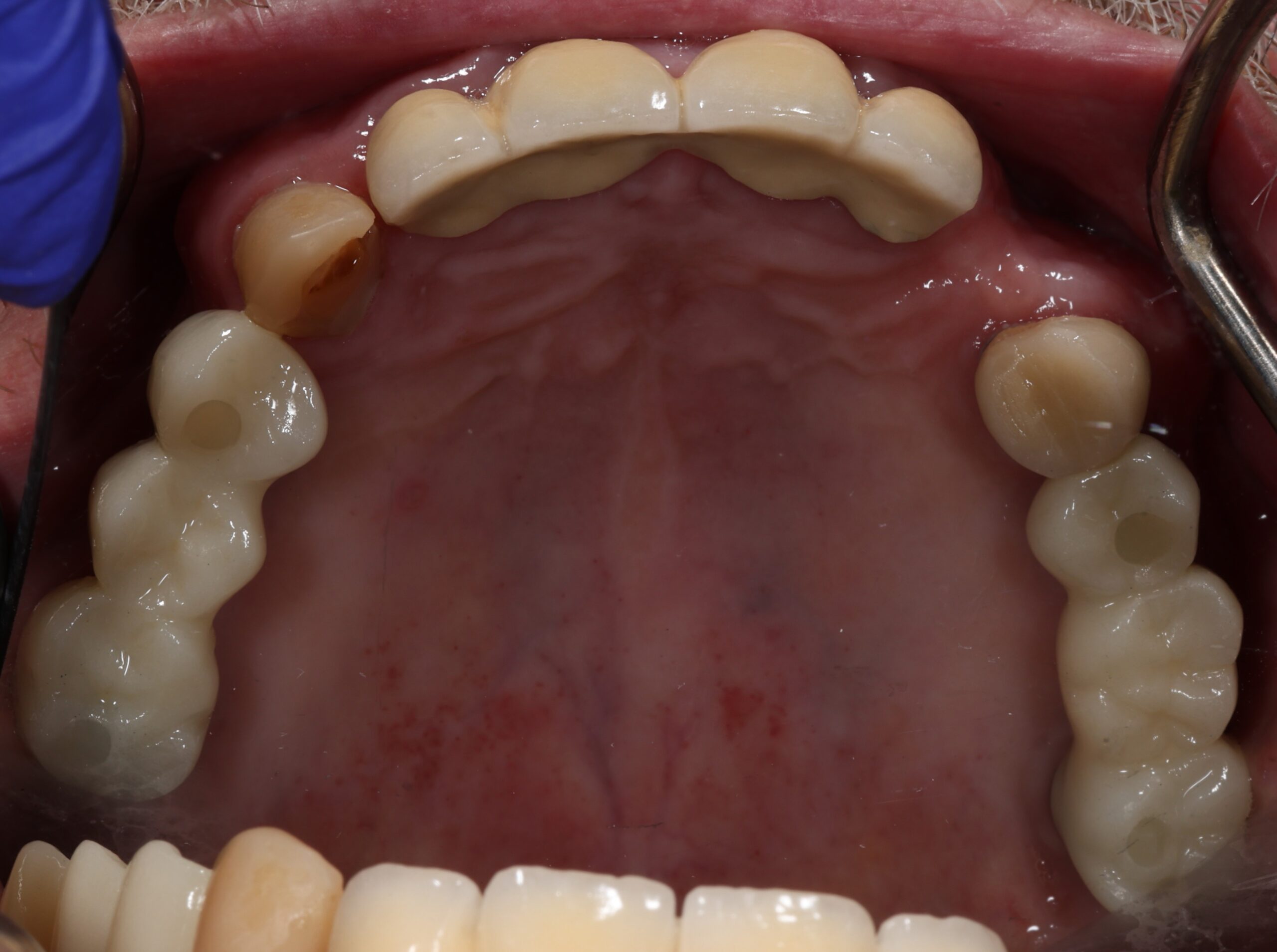 Patient 6 FMR Before 5 scaled - Dental Associates of Jersey City