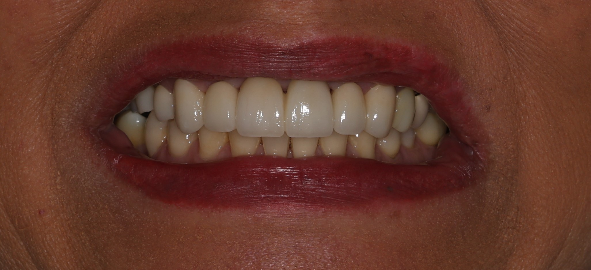 Patient 7 After 1 - Dental Associates of Jersey City