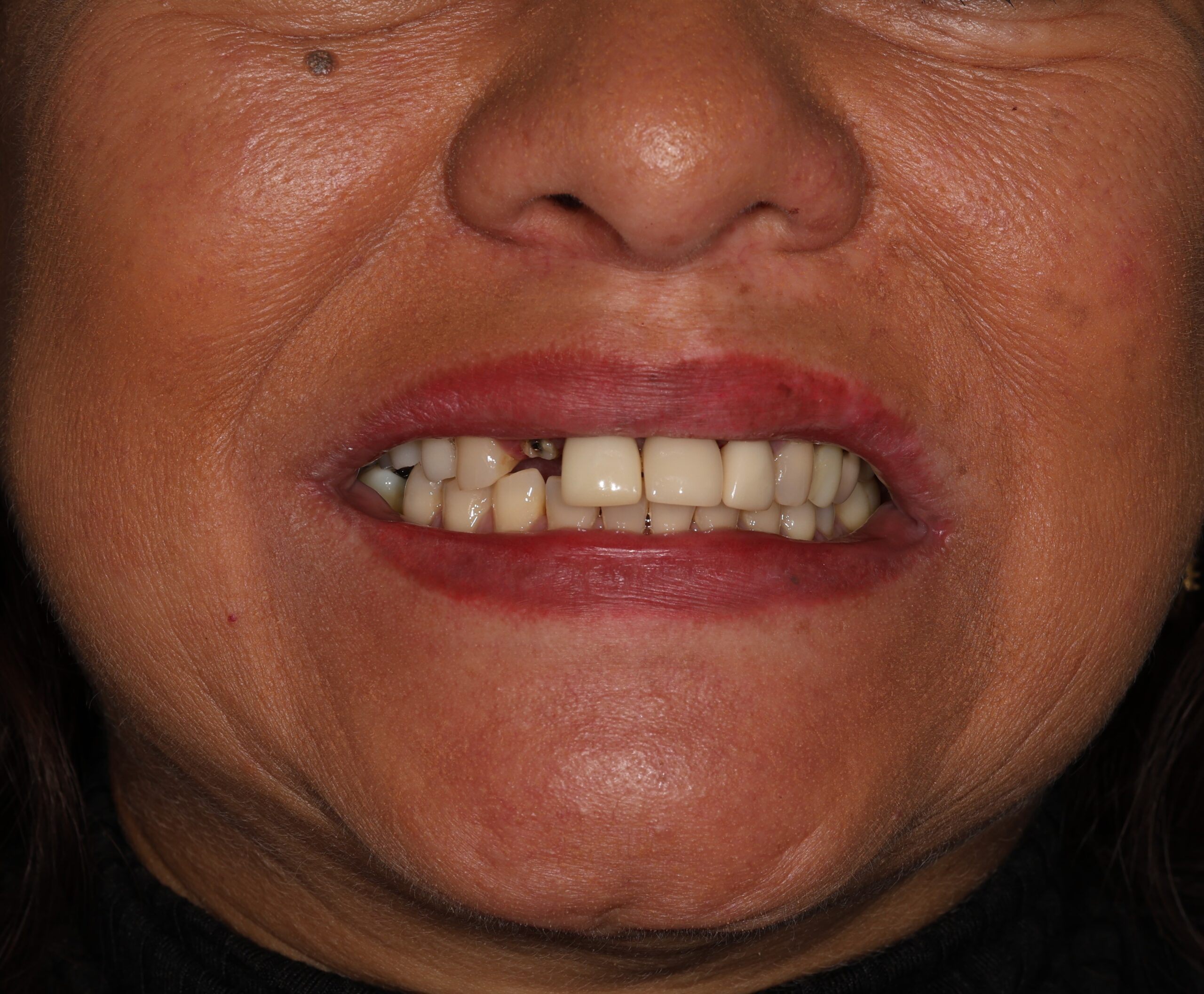 Patient 7 Before scaled - Dental Associates of Jersey City