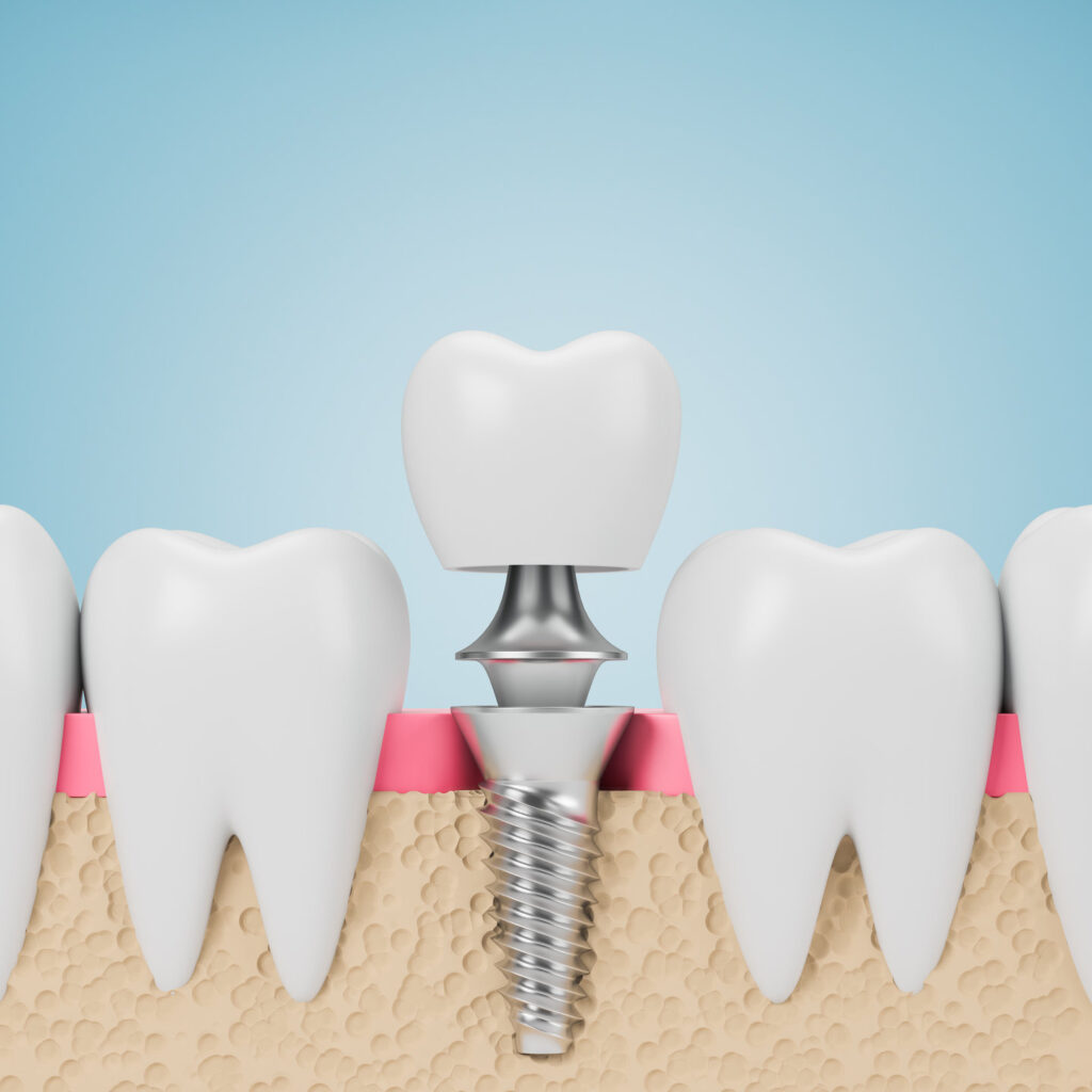 Row of teeth with implant screw over blue background. Concept of dental hygiene and care. 3d rendering