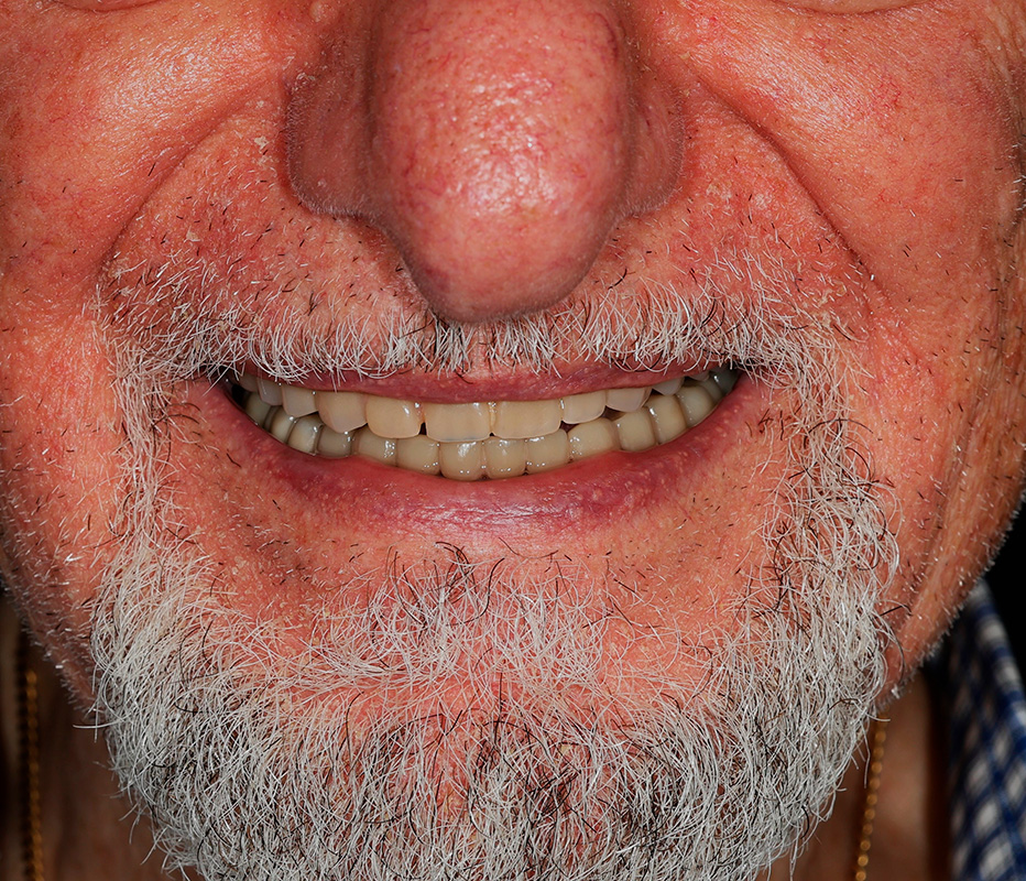 Patient 1 After 1 - Dental Associates of Jersey City