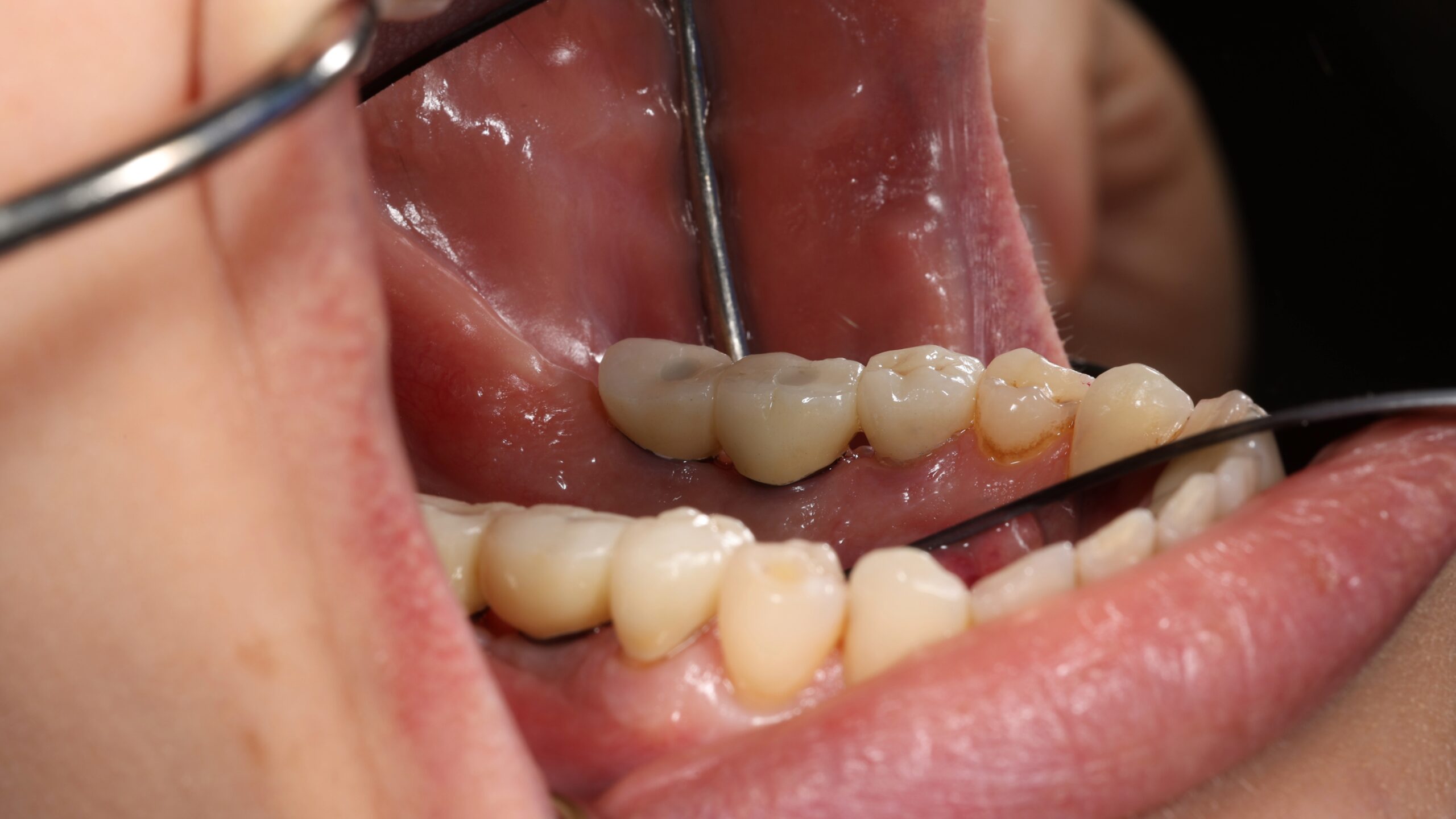 Patient 11 After scaled - Dental Associates of Jersey City