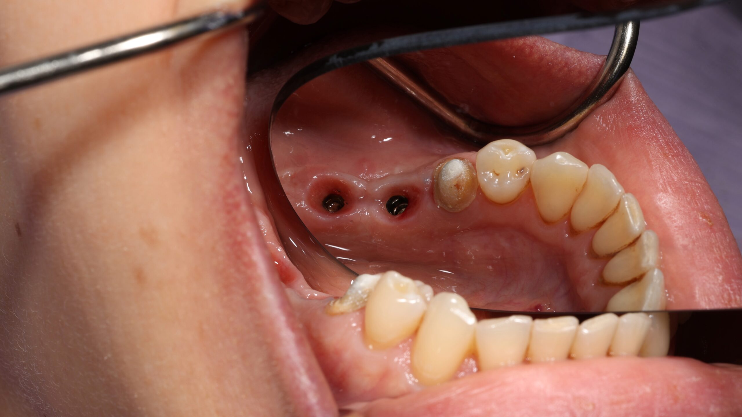 Patient 11 Before scaled - Dental Associates of Jersey City