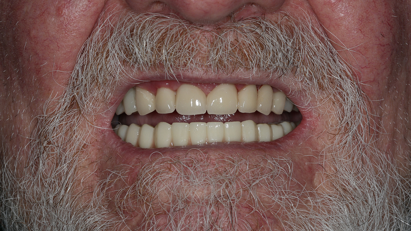 Patient 13 After - Dental Associates of Jersey City