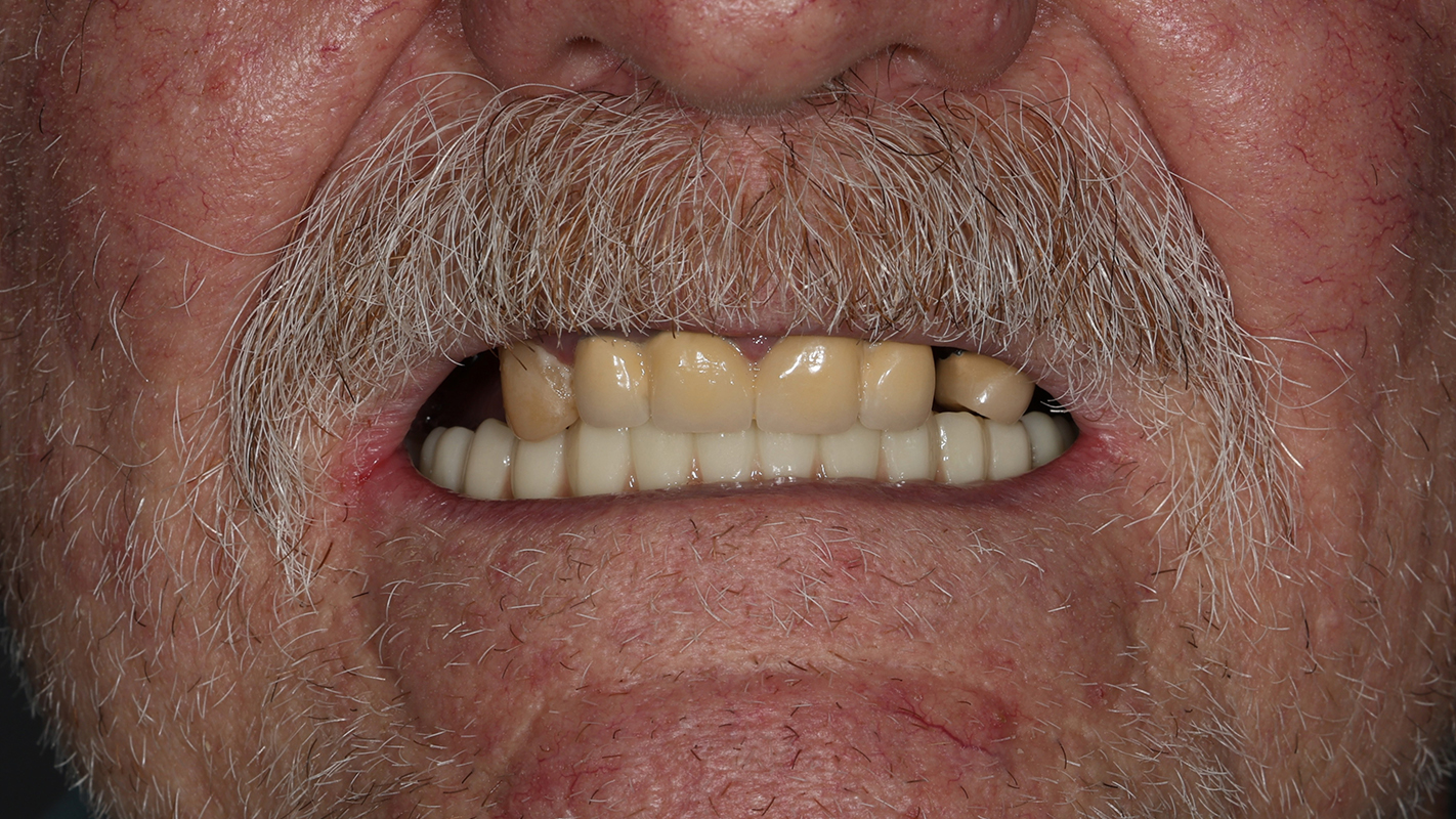 Patient 13 Before - Dental Associates of Jersey City