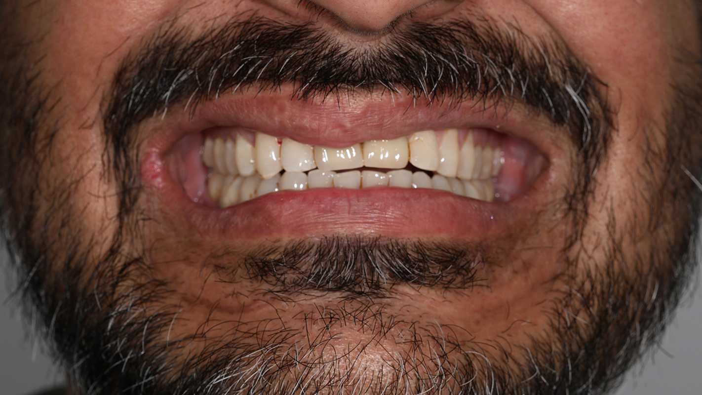 Patient 18 After - Dental Associates of Jersey City