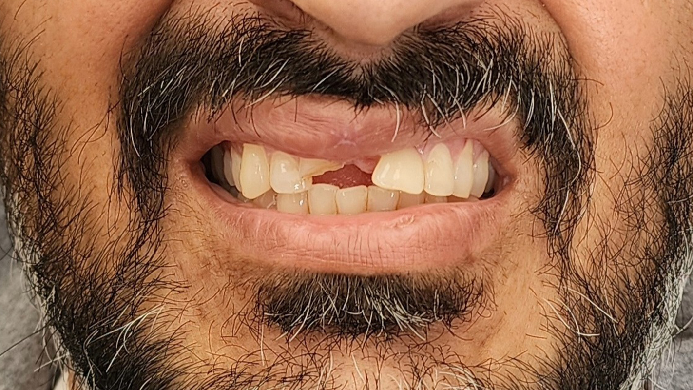 Patient 18 Before - Dental Associates of Jersey City