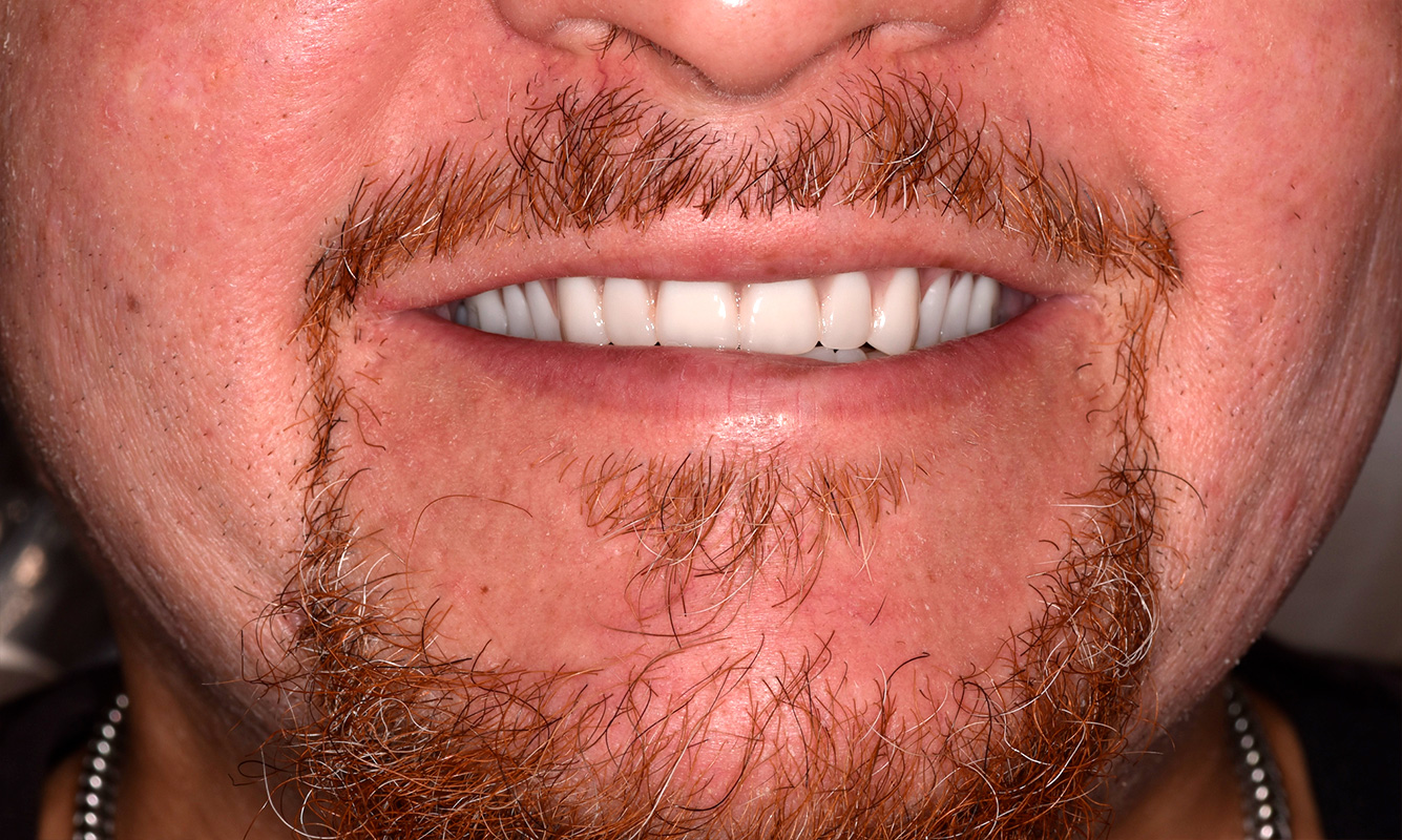 Patient 4 after - Dental Associates of Jersey City